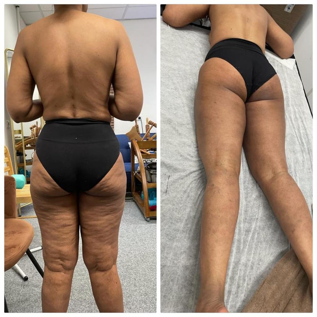 Cellulite Treatments Amsterdam