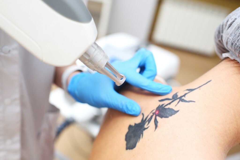 Laser tattoo removal treatment at Beauty Lounge Amsterdam removing unwanted tattoo safely and effectively.